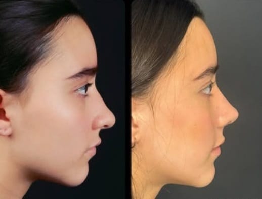 Rinoplastia caso 11 — antes y después
